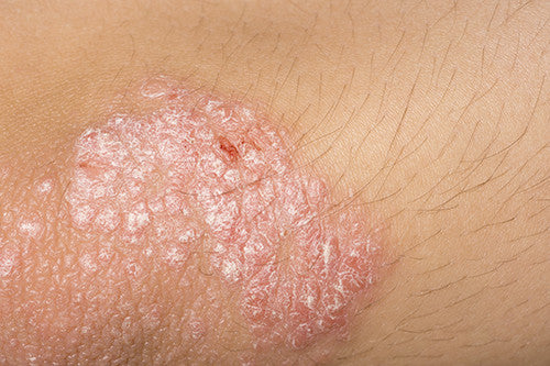 Eliminate Psoriasis